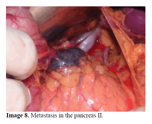 pancreas-metastasis-pancreas-II