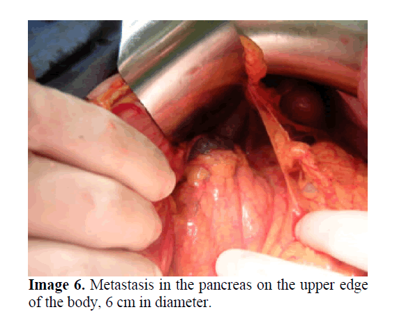 pancreas-metastasis-pancreas-upper-edge