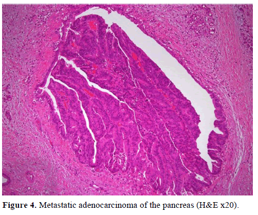 pancreas-metastatic-adenocarcinoma