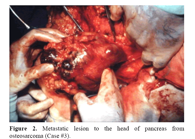 pancreas-metastatic-lesion-head