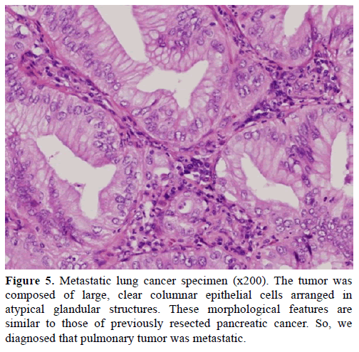 pancreas-metastatic-lung-cancer