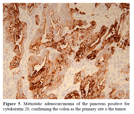 pancreas-metastatic-primary-site