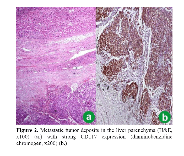 pancreas-metastatic-tumor-deposits