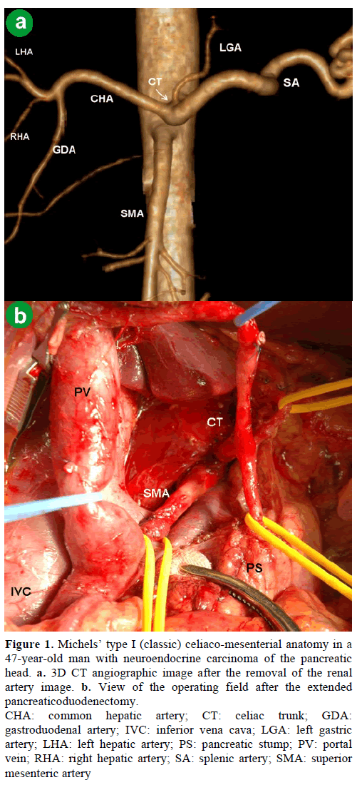 pancreas-michels-type-i-celiaco-mesenterial