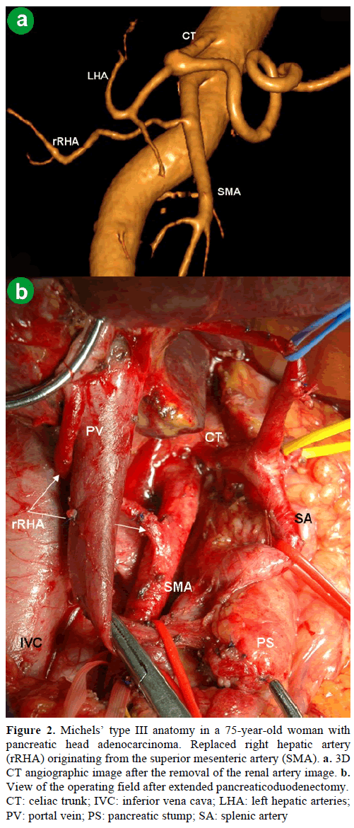pancreas-michels-type-iii-anatomy-hepatic