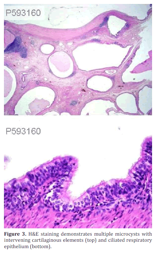 pancreas-microcysts-cartilaginous-elements