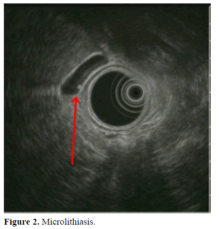 pancreas-microlithiasis