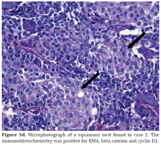 pancreas-microphotograph-squamous