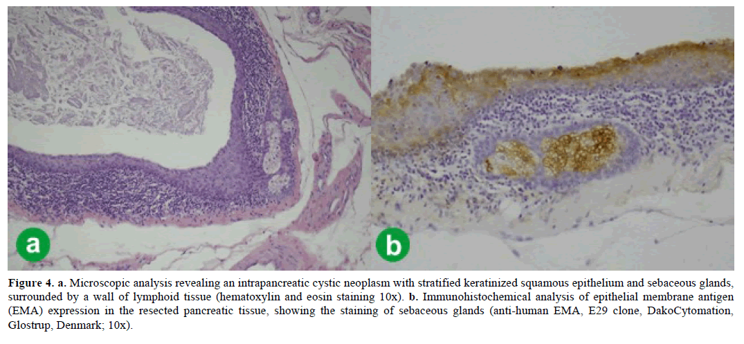 pancreas-microscopic-analysis-neoplasm