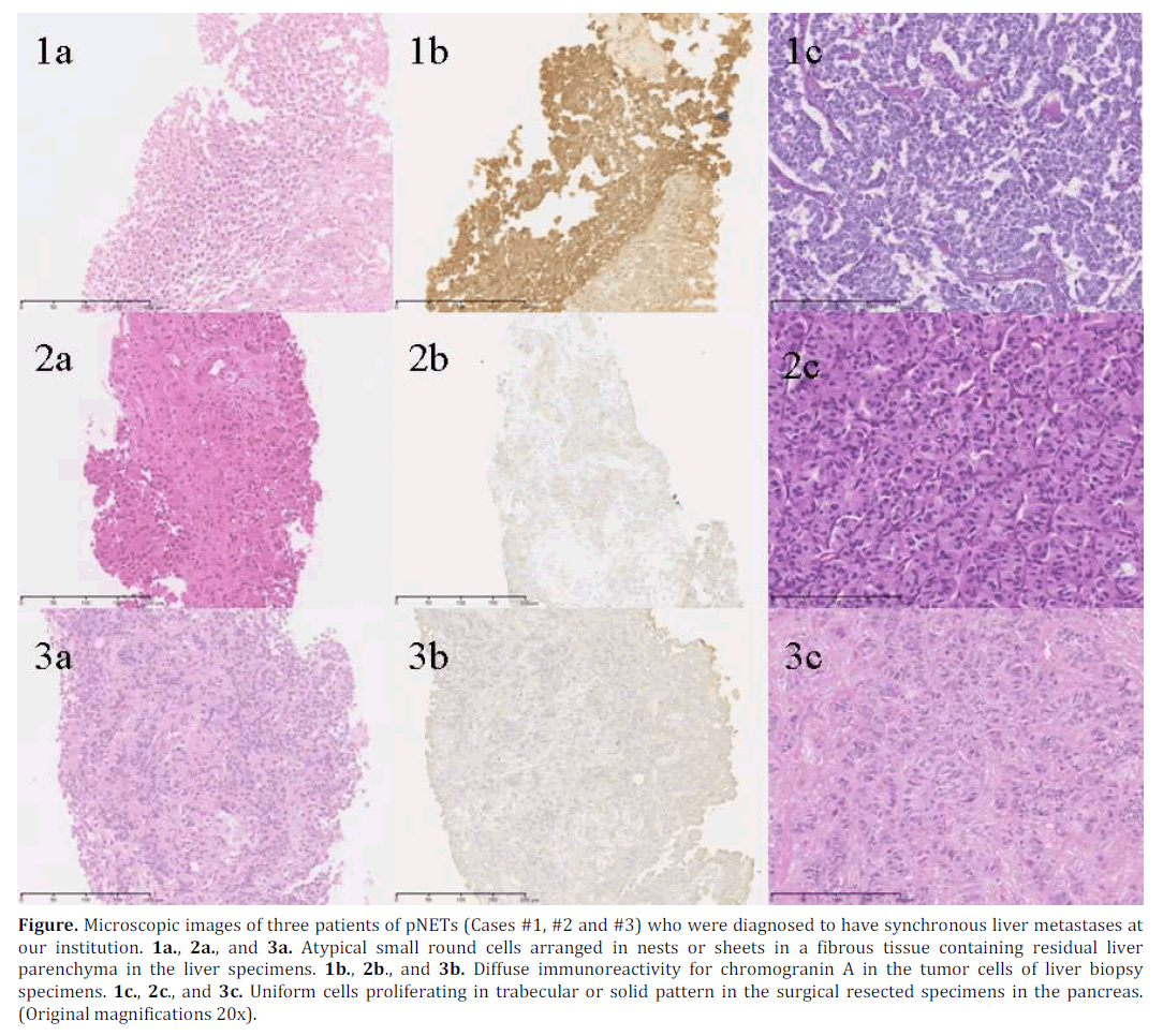 pancreas-microscopic-diagnosed-synchronous