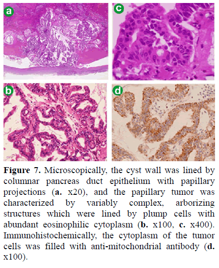pancreas-microscopically-cyst-wall-columnar
