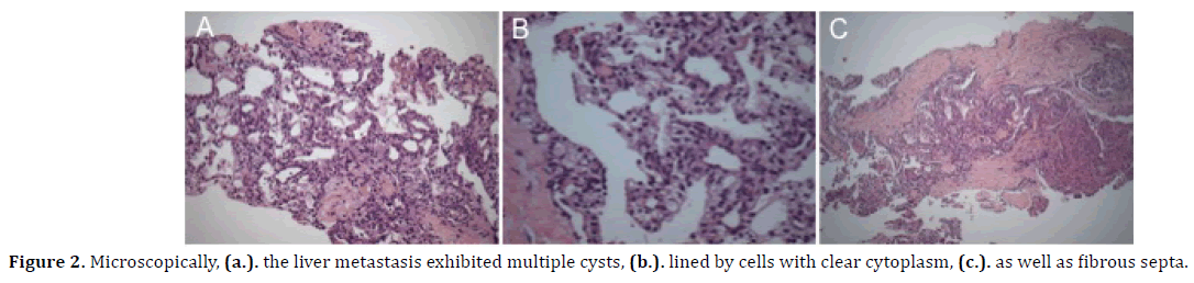 pancreas-microscopically-metastasis