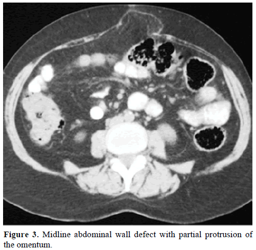pancreas-midline-abdominal-wall-defect