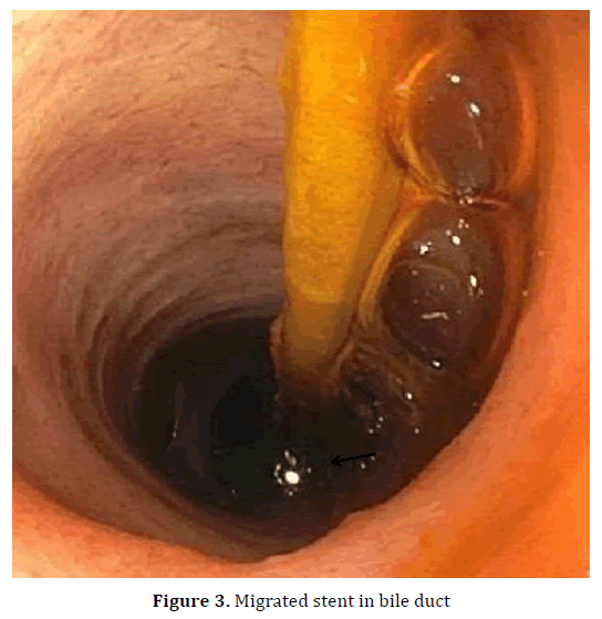 pancreas-migrated-stent-bile-duct