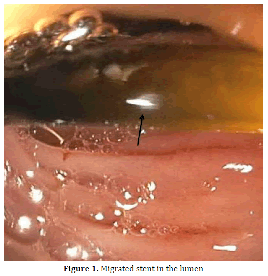 pancreas-migrated-stent-lumen