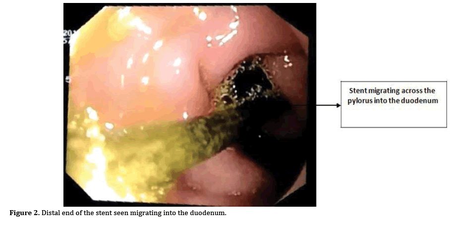 pancreas-migrating