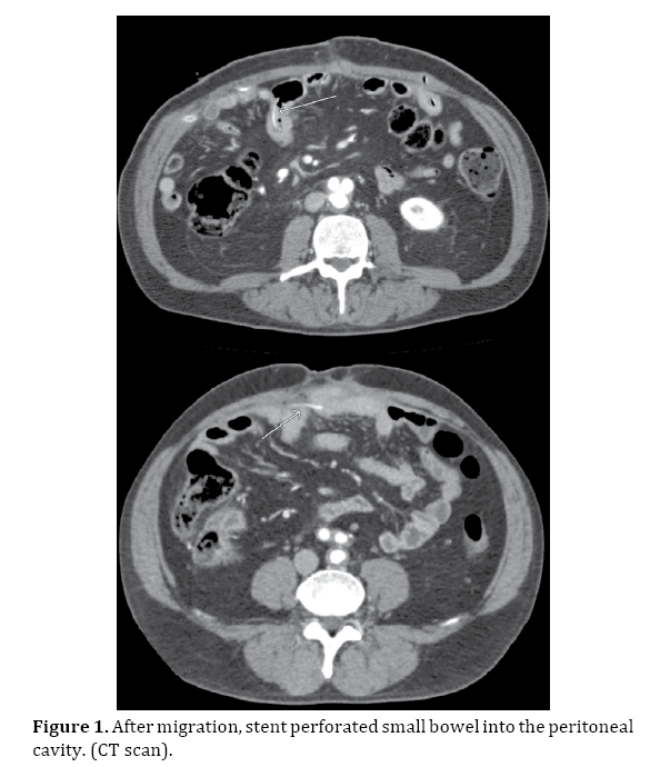 pancreas-migration-stent-perforated