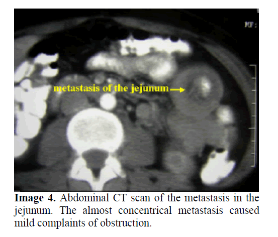 pancreas-mild-complaints-obstruction