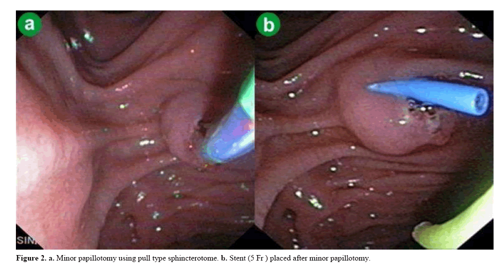 pancreas-minor-papillotomy-using