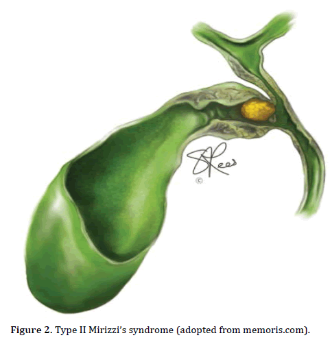 pancreas-mirizzi