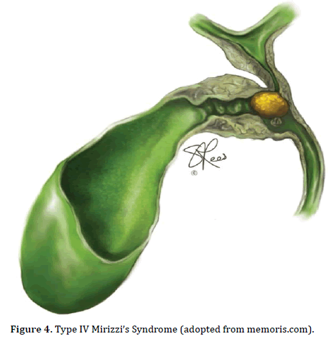 pancreas-mirizzi-memoris