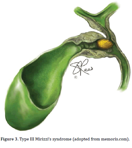 pancreas-mirizzi-syndrome