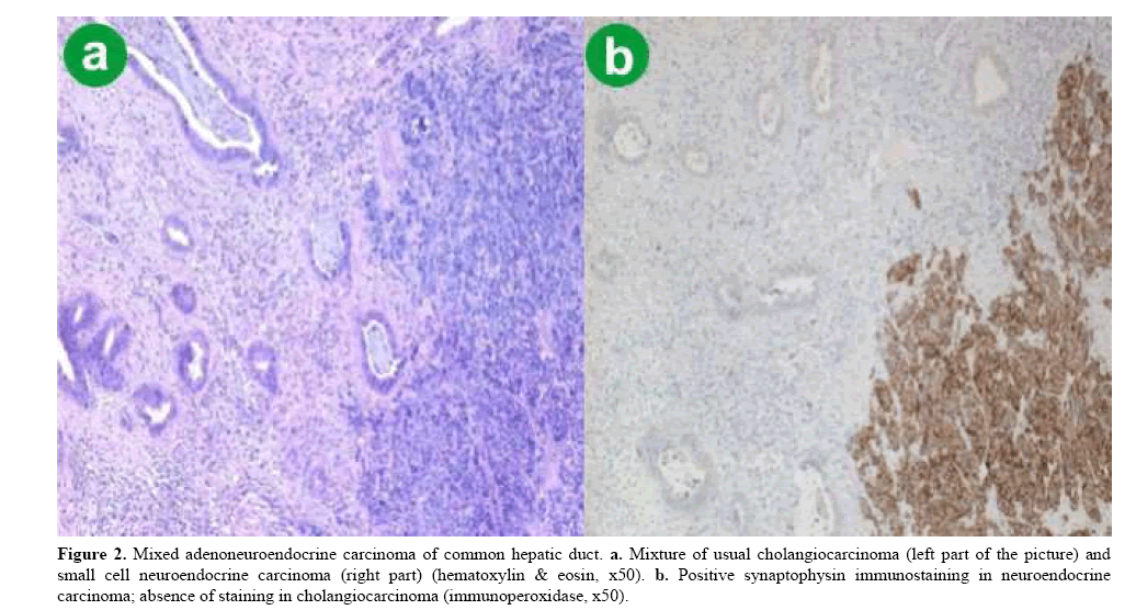 pancreas-mixed-adenoneuroendocrine