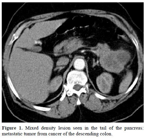 pancreas-mixed-density-lesion-tail