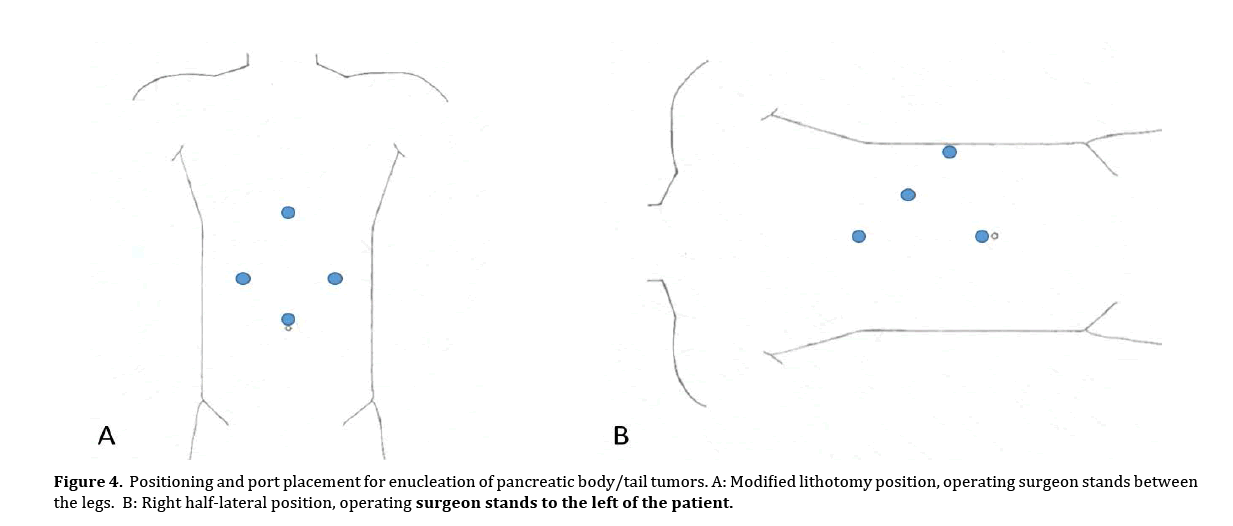 pancreas-modified-lithotomy-position