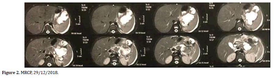 pancreas-mrcp