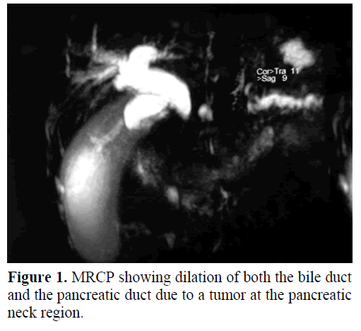 pancreas-mrcp-dilation-bile-duct