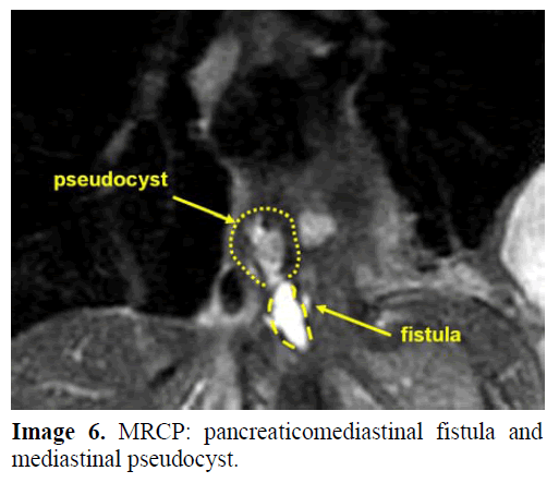 pancreas-mrcp-mediastinal-pseudocyst