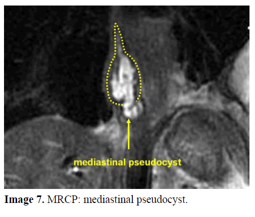 pancreas-mrcp-mediastinal-pseudocyst