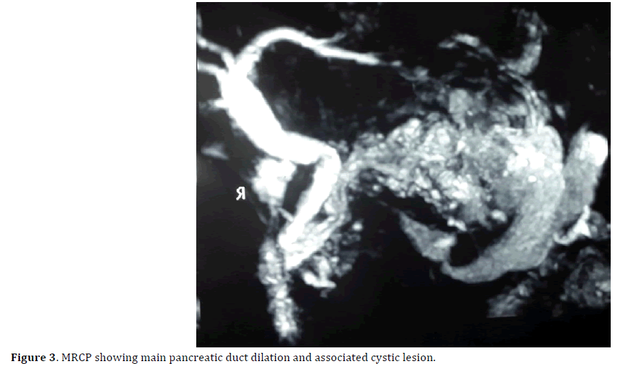 pancreas-mrcp-pancreatic-dilation