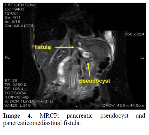 pancreas-mrcp-pancreatic-fistula