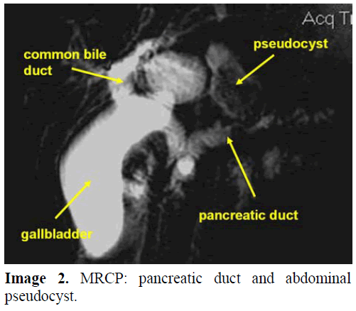 pancreas-mrcp-pancreatic-pseudocyst