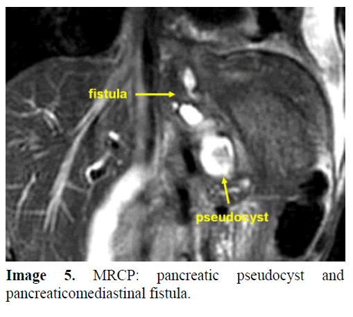 pancreas-mrcp-pancreatic-pseudocyst