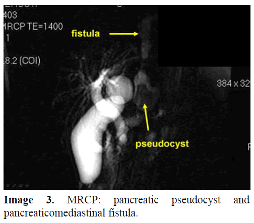 pancreas-mrcp-pancreaticomediastinal