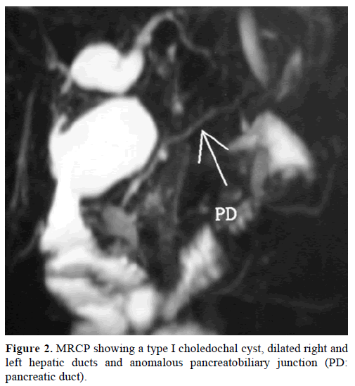 pancreas-mrcp-type-i-choledochal-cyst