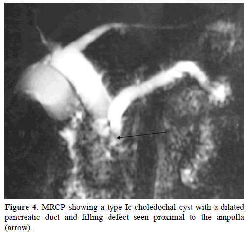 pancreas-mrcp-type-ic-choledochal-cyst