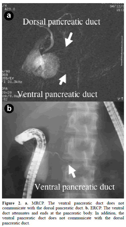 pancreas-mrcp-ventral-pancreatic-duct