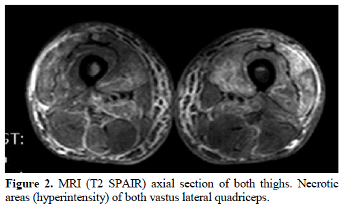 pancreas-mri-axial-section-necrotic