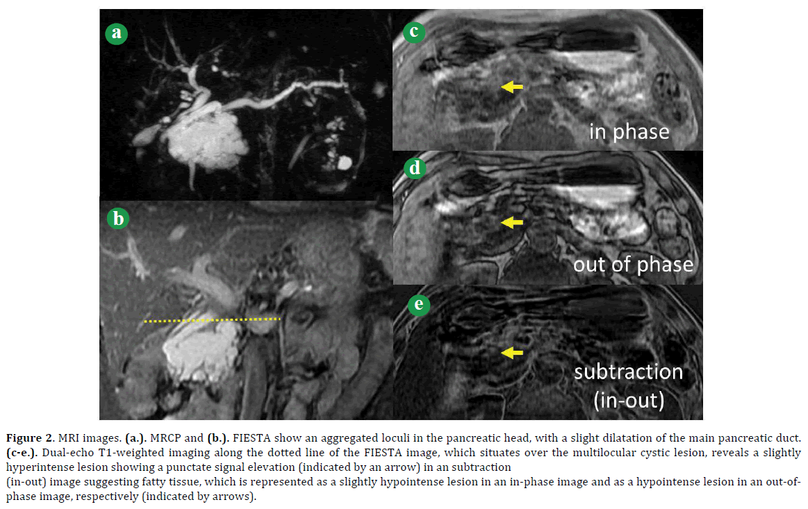 pancreas-mri-images-mrcp-fiesta-loculi