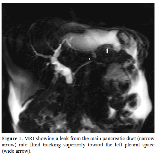 pancreas-mri-leak-main-pancreatic