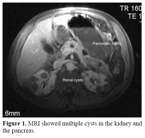 pancreas-mri-multiple-cysts-kidney