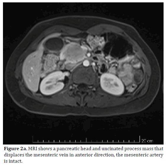 pancreas-mri-pancreatic-head