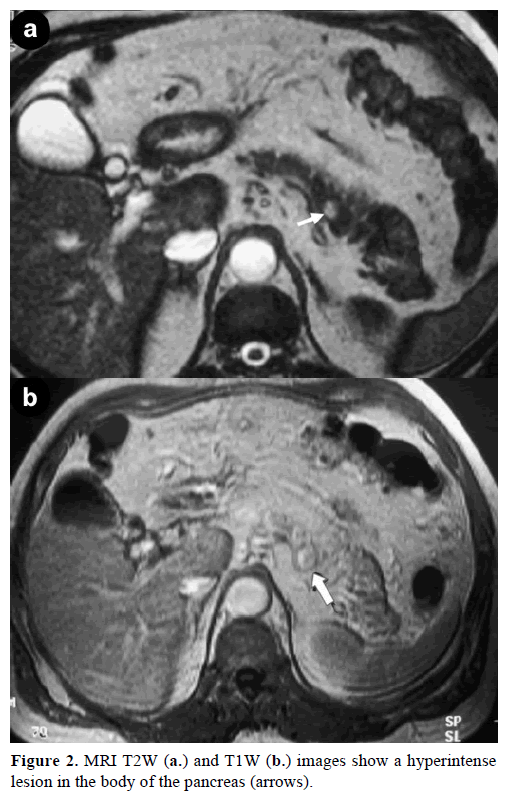 pancreas-mri-t2w-hyperintense-lesion