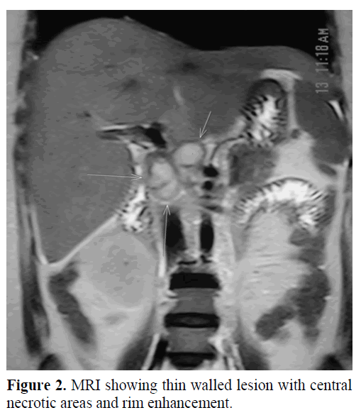 pancreas-mri-walled-lesion-necrotic-areas