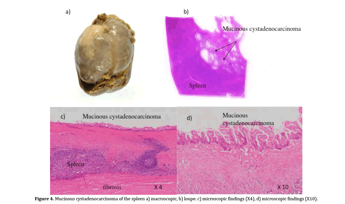 pancreas-mucinous-cystadenocarcinoma