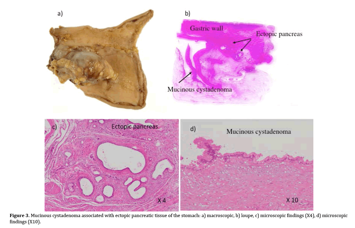 pancreas-mucinous-cystadenoma-associated